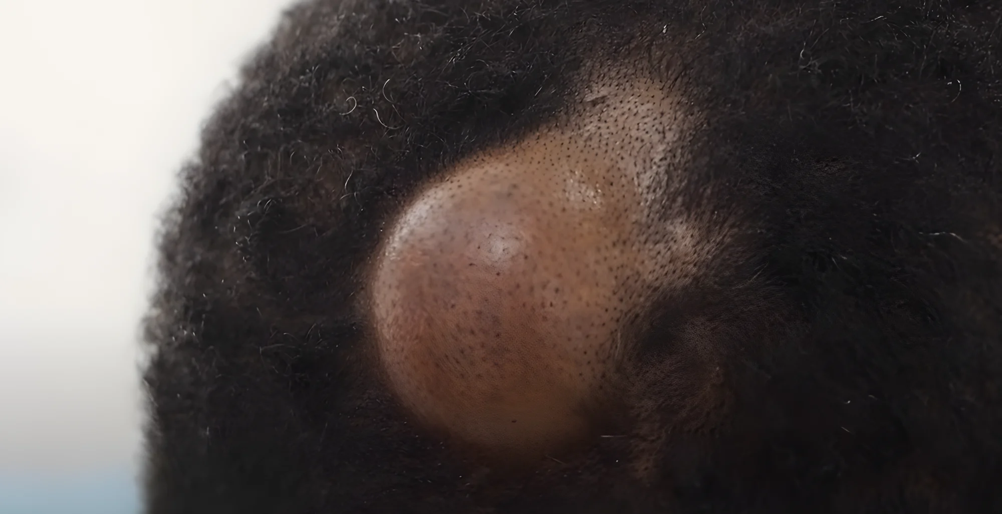 Dr. MD. Sabir Pasha - Lipoma & Cyst Removal Surgery Specialist